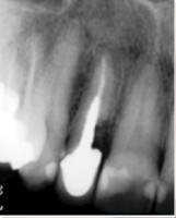 /album/galeria-de-fotos-carga-imediata-apos-exodontia-atraumatica-/carga-imediata-com-exodontia-atraumatica1-jpg/